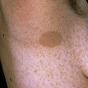 Nörofibromatozis-1