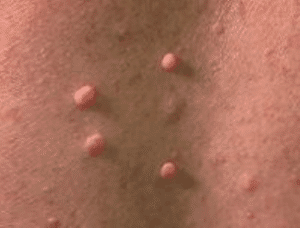 Nörofibromatozis-3