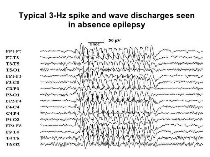 ABSANS EPİLEPSİ